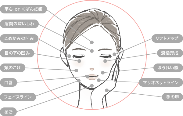 Uses for HA fillers - 治療できる部位